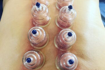 Sports Cupping